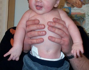 Bilden visar en 4 månader gammal gosse med C5-C6-skada i bägge armarna efter en sätesförlossning.